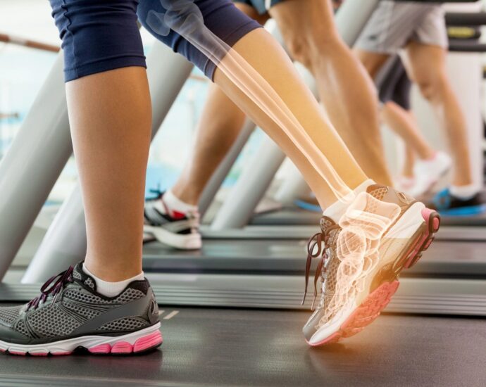 x-rayed foot on treadmill